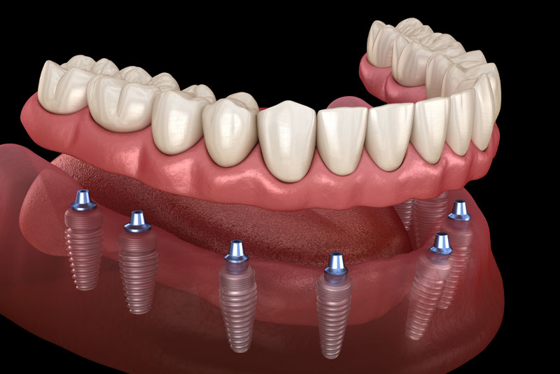 full mouth dental implants model.