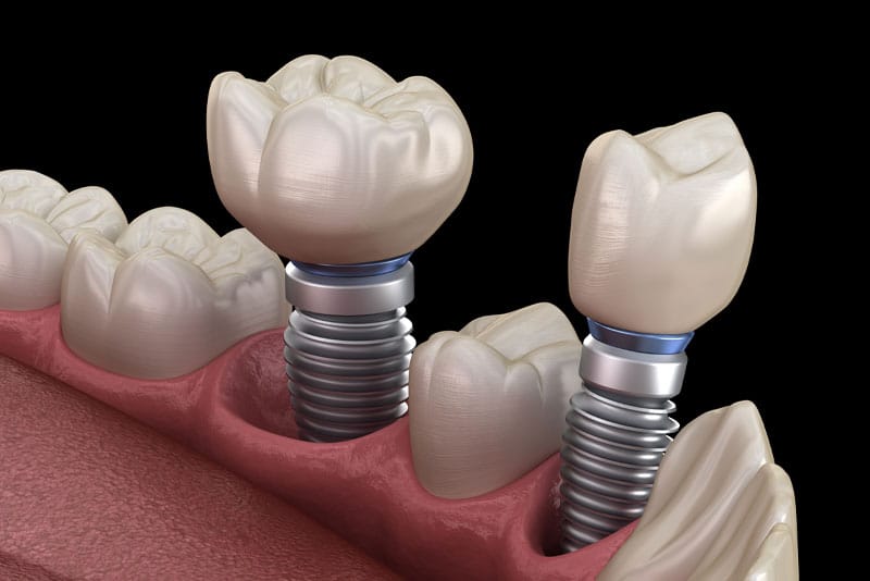 a digital model of a lower jaw showing two o dental implant posts.