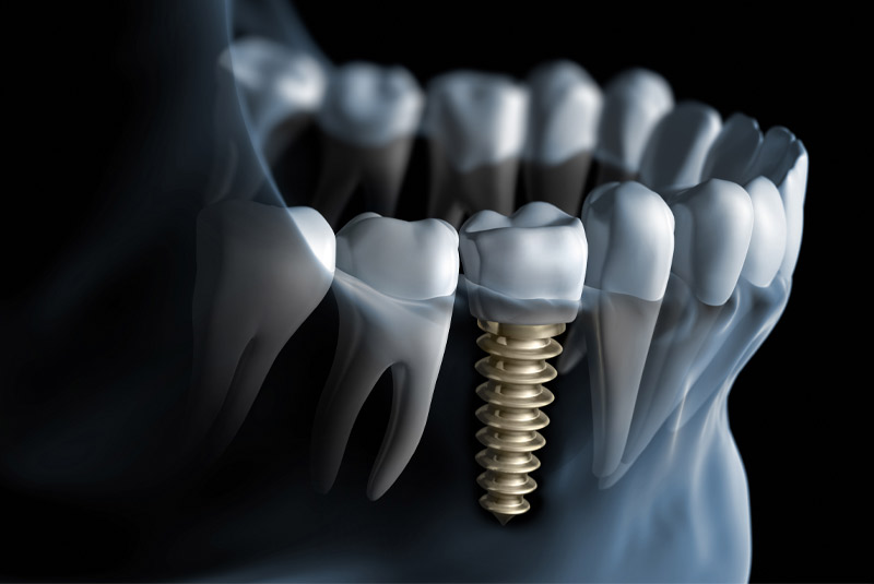 Dental implant example model