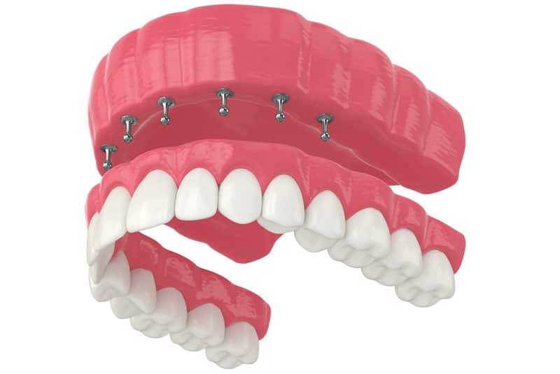 a digital model of a snap on full mouth dental implant.