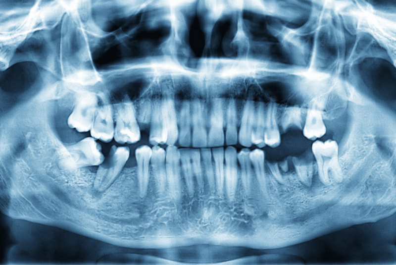 Missing teeth x-ray