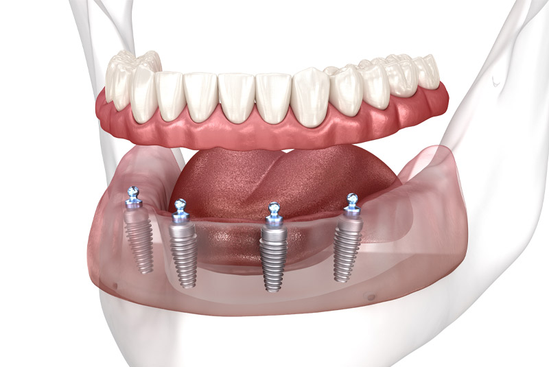 Denture example model