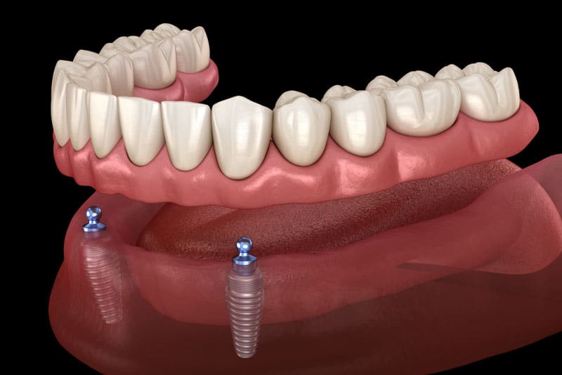 an implant supported denture model that can show patients how their mouth can be restored with the dental implant posts, abutments, and a denture.