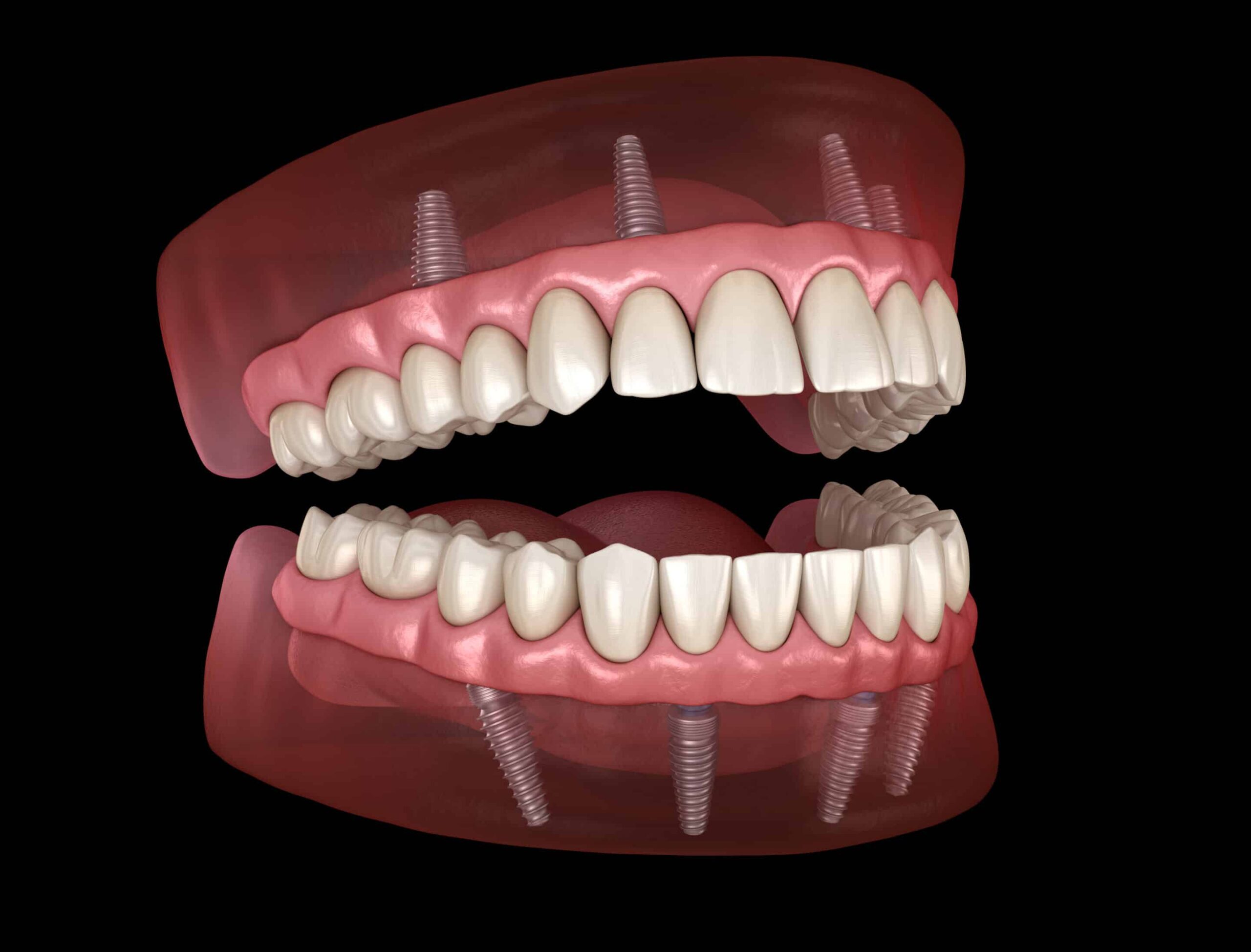 Full Mouth dental implants Maxillary and Mandibular prosthesis with gum All on 4 system supported by implants. Medically accurate 3D illustration of human teeth and dentures