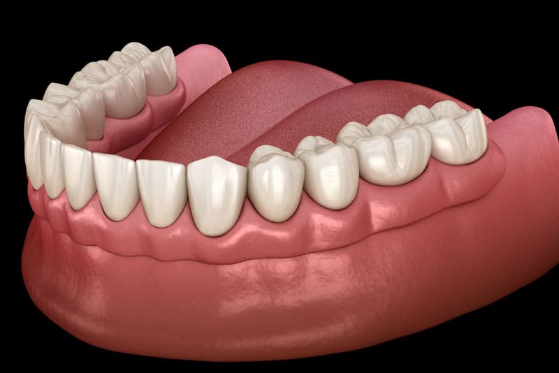 a 3D image of traditional dentures in Mesa, AZ.