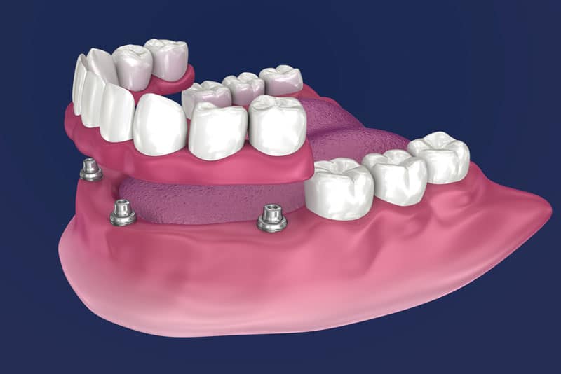 an image of snap on dentures.