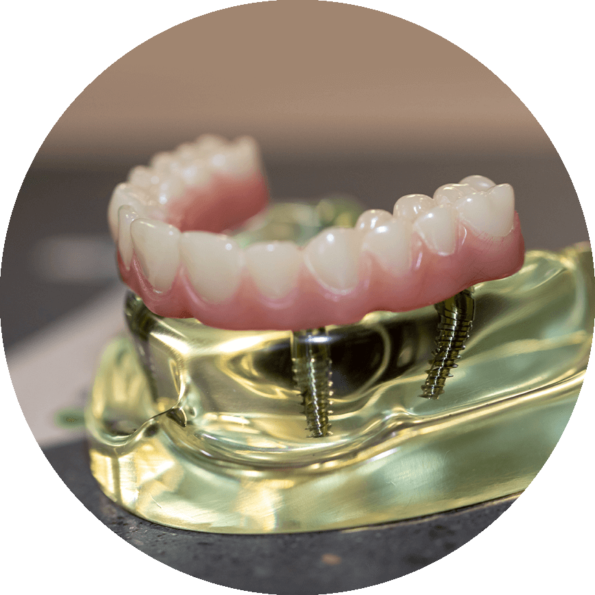 All-On-4 Dental Implants Model
