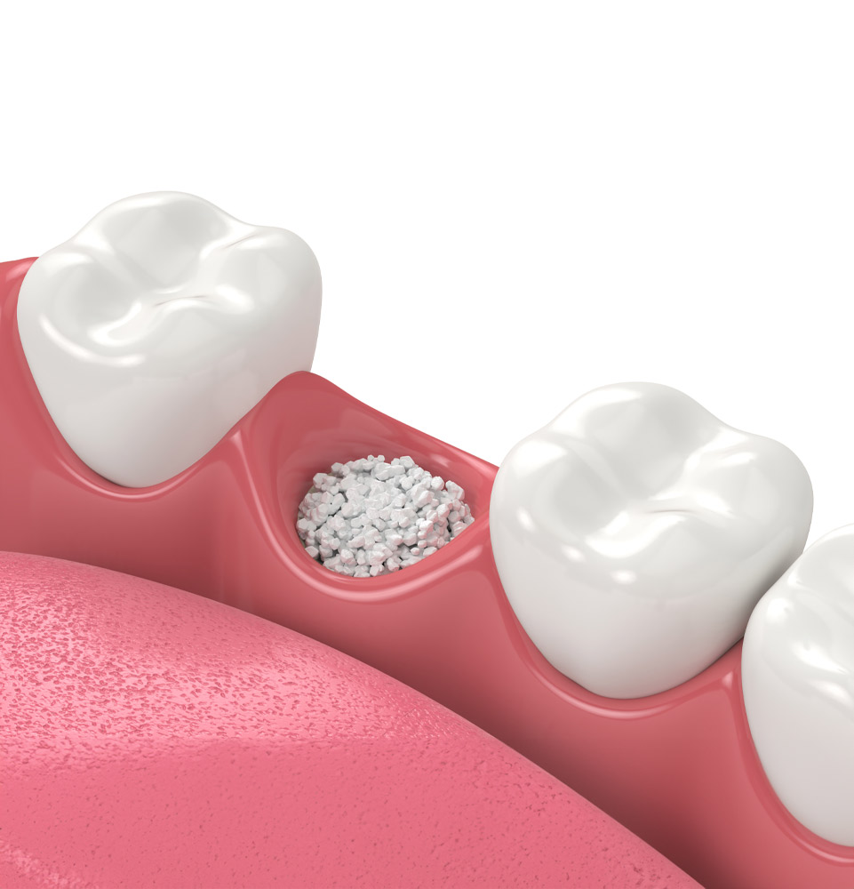 Bone grafting treatment