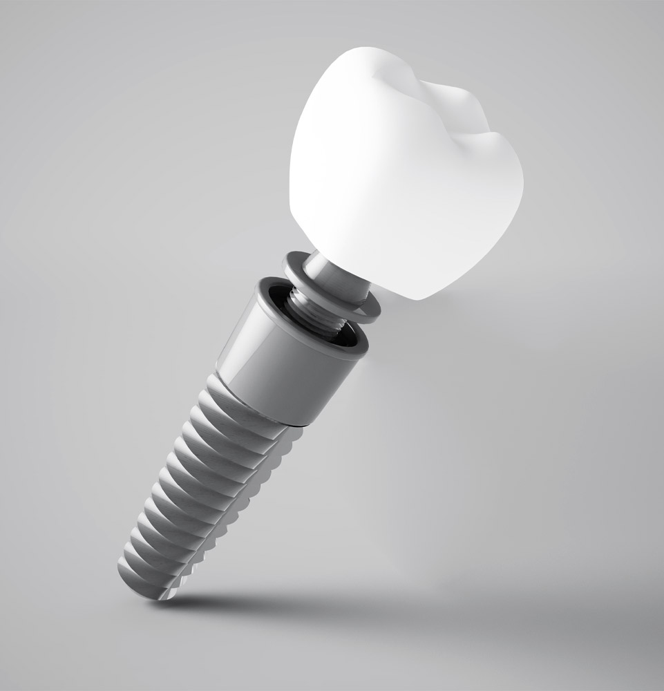 Dental implant example model.