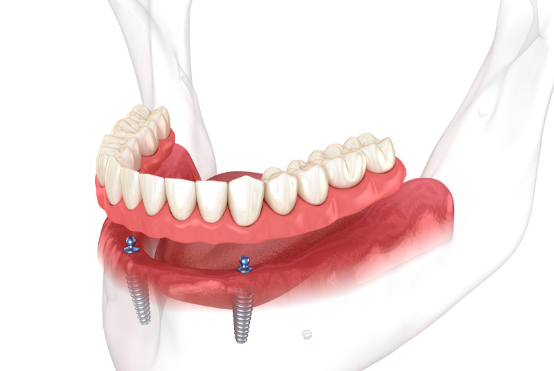 Implant Supported Dentures