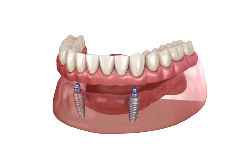 Denture example model