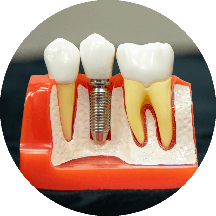 Single Implant In A Bone Cutaway Model