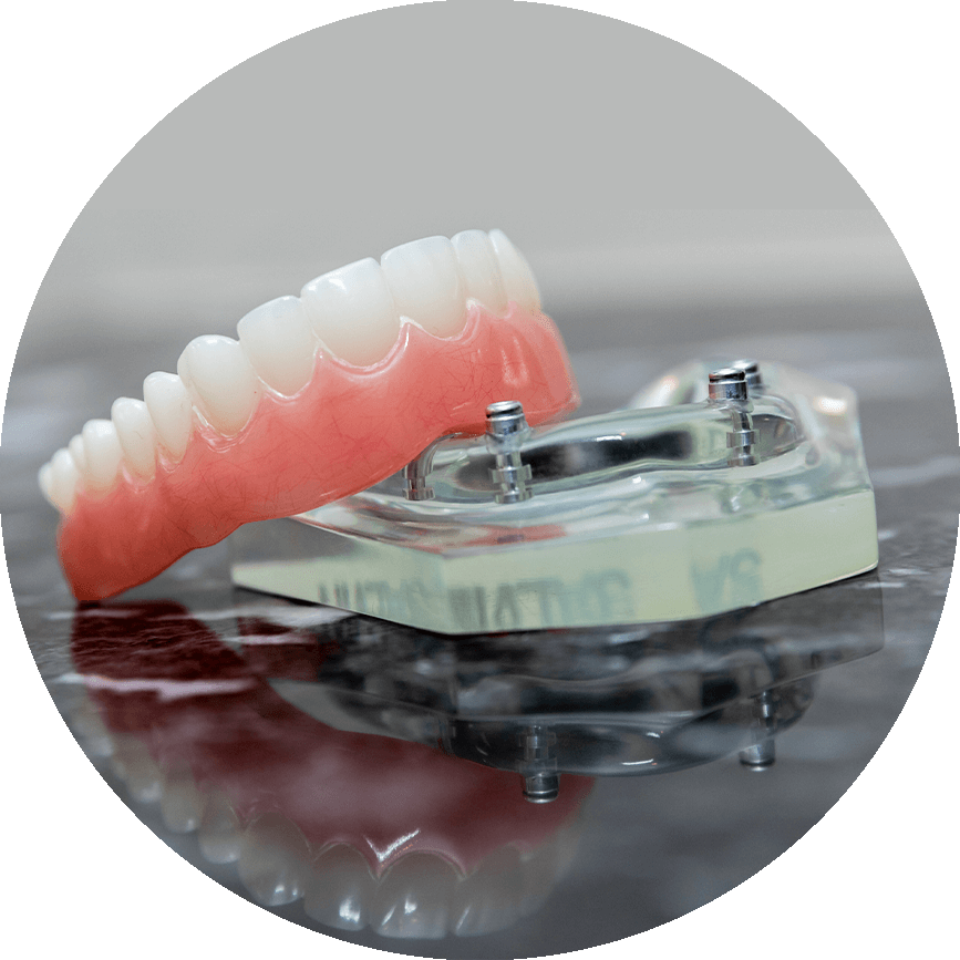 Snap In Dentures Model