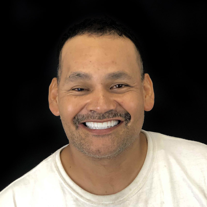 All On 4 Dental Implant Patient After