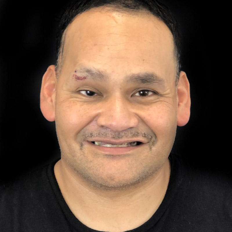 All On 4 Dental Implant Patient Before