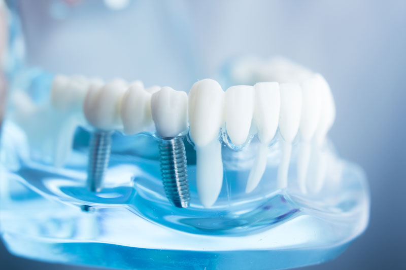 clear display of a dental implant placed into a transparent jaw