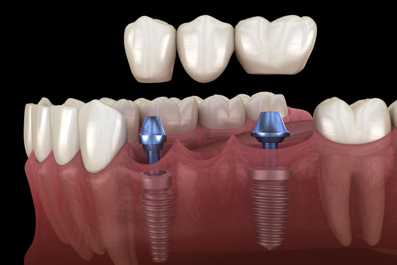 a bridge floating above 2 dental implants placed into the jaw