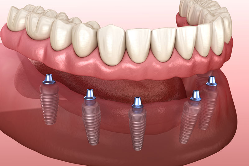 a snap on denture with 6 implants in their jaw