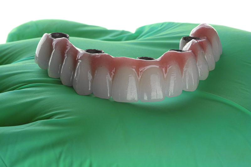 a full arch of teeth with 4 implant holes for implants to be placed into the jaw