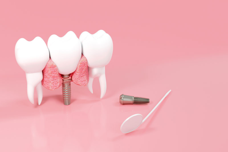 an implant tooth surrounded by 2 teeth and a mirror on the side