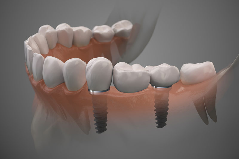 Discover the benefits of snap-on dentures in Chandler, AZ with Dr. Alyssa Mencini at Restore Denture & Implant Center.