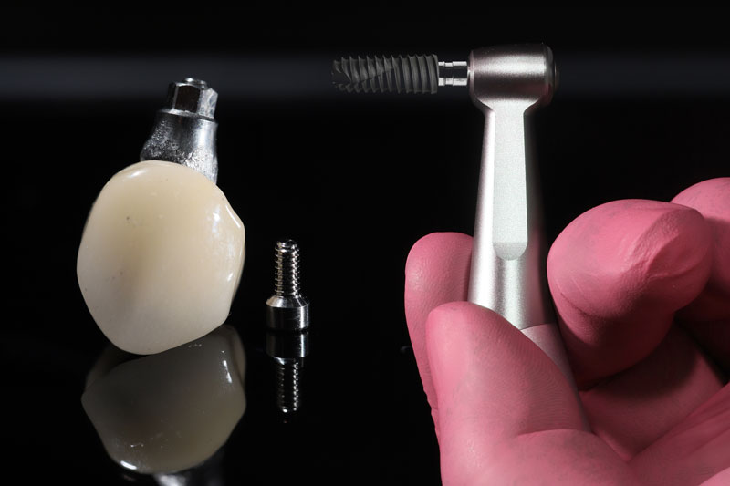 a single dental implant with a doctor holding up a tool to place the implant