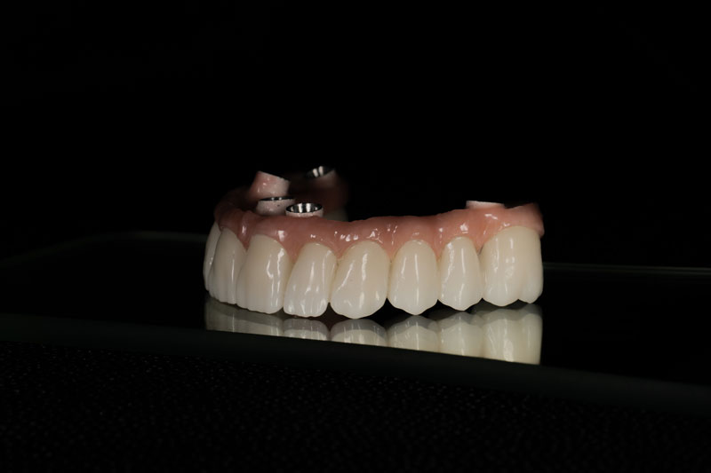 all on 4 dental implants with a full arch going across it