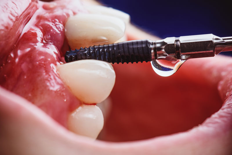 a single dental implant bieng placed into the jaw