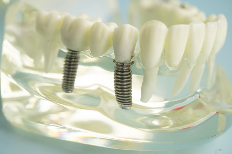 2 single dental implants placed into a clear jaw model with a crown on top