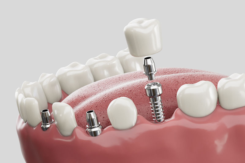 3 single dental implants conected to the crown on top