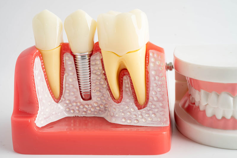 a dental implant model with 2 teeth next to it and a full arch