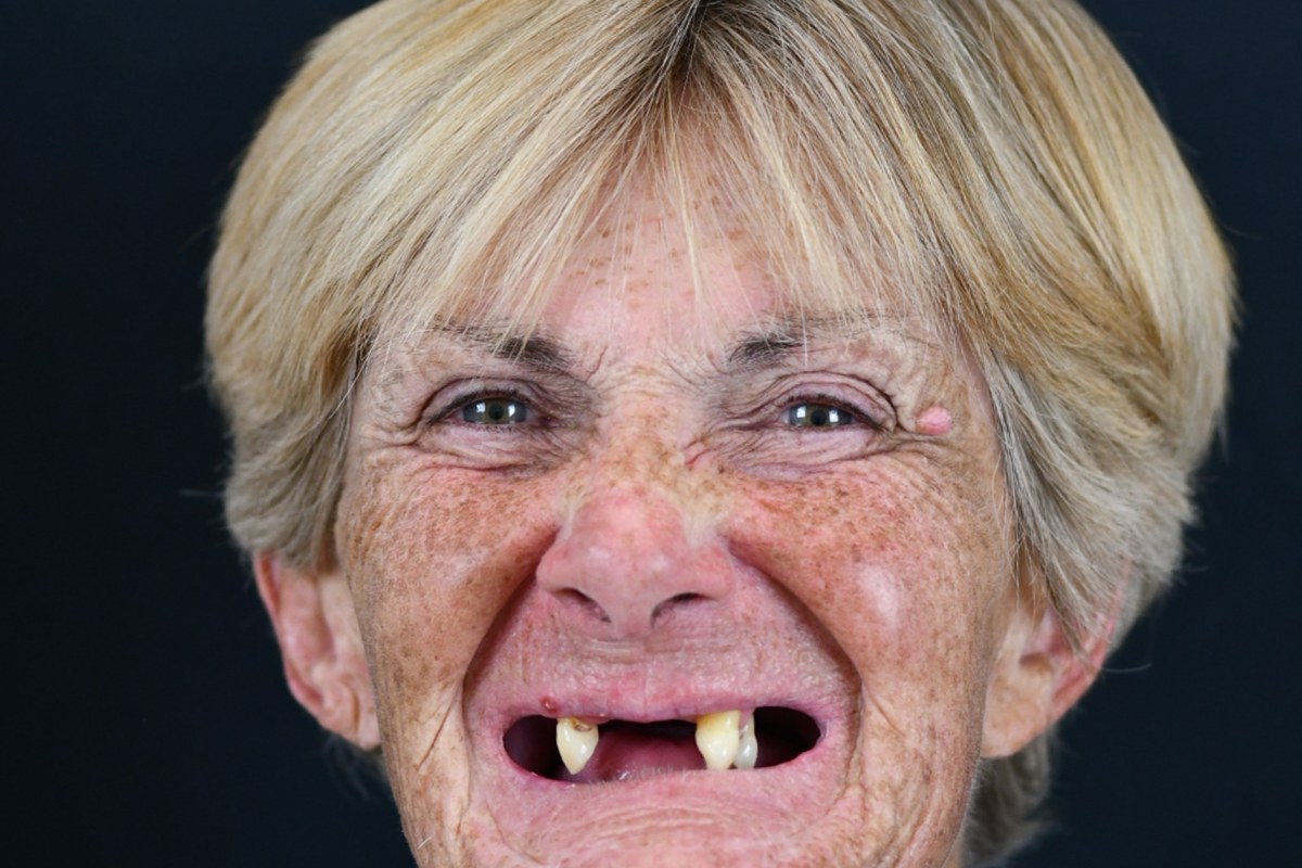 Restore patient before dental implant treatment