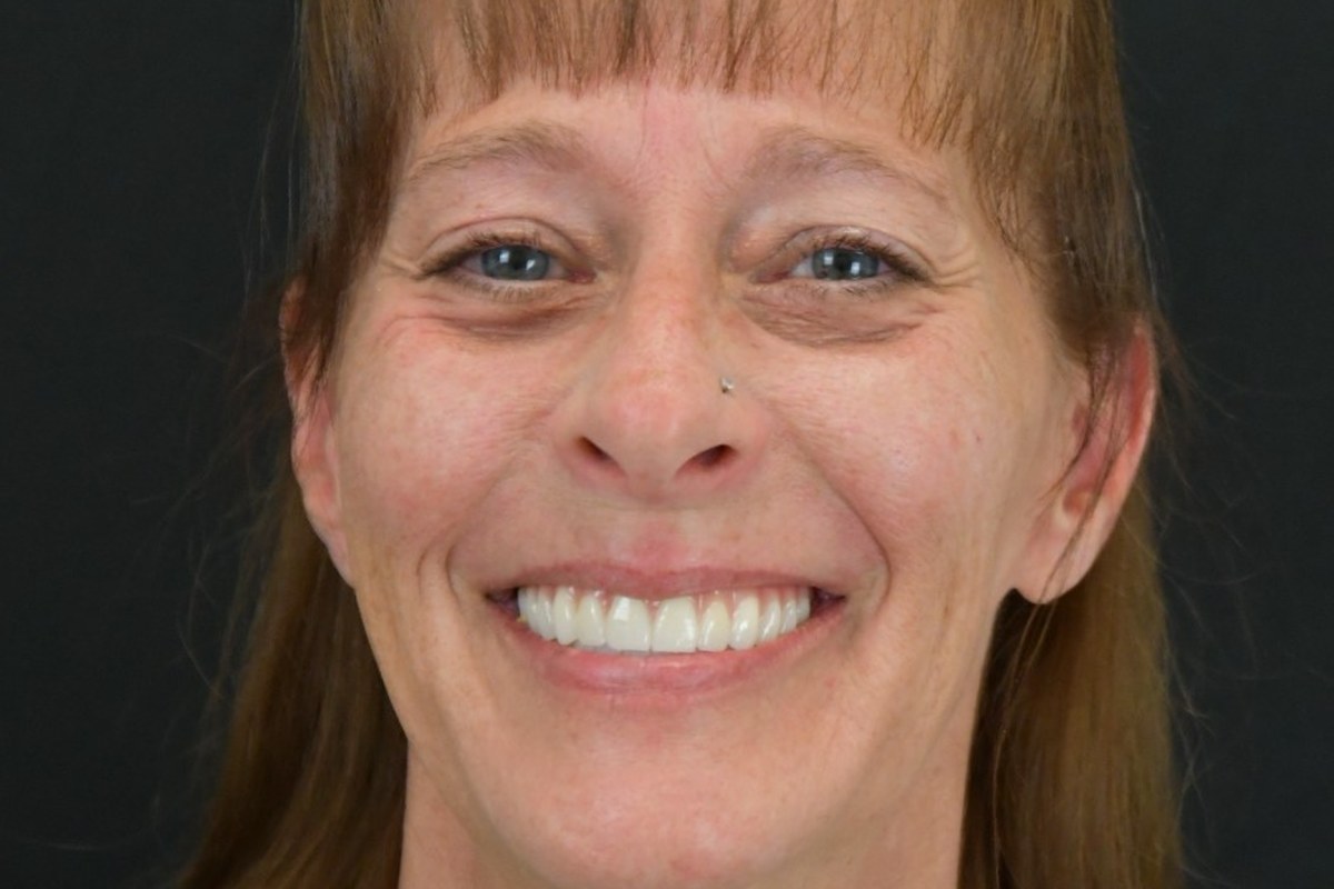 Restore patient after dental implant treatment