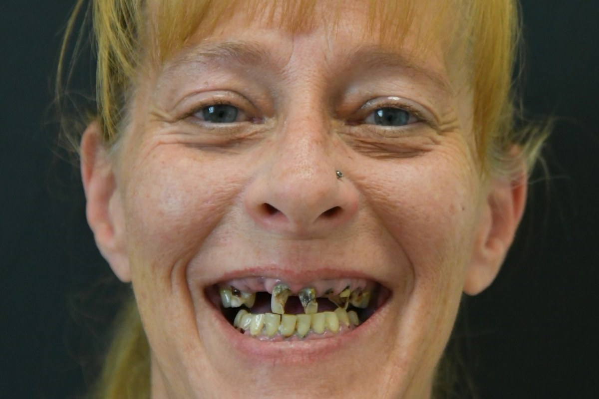 Restore patient before dental implant treatment