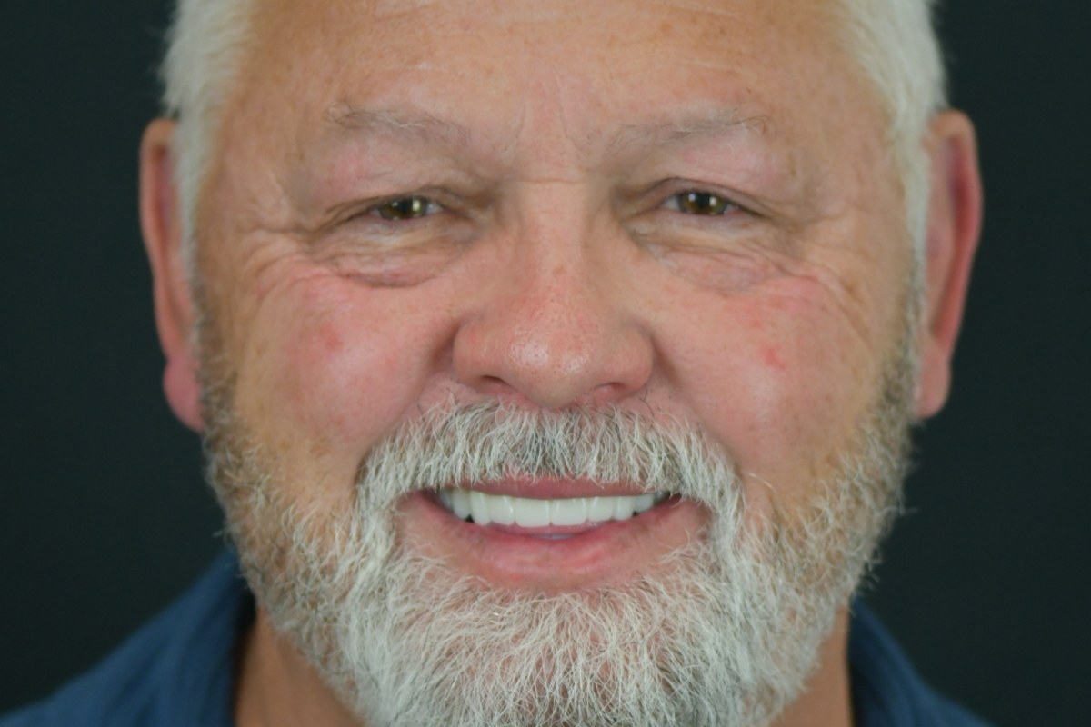 Restore patient after dental implant treatment