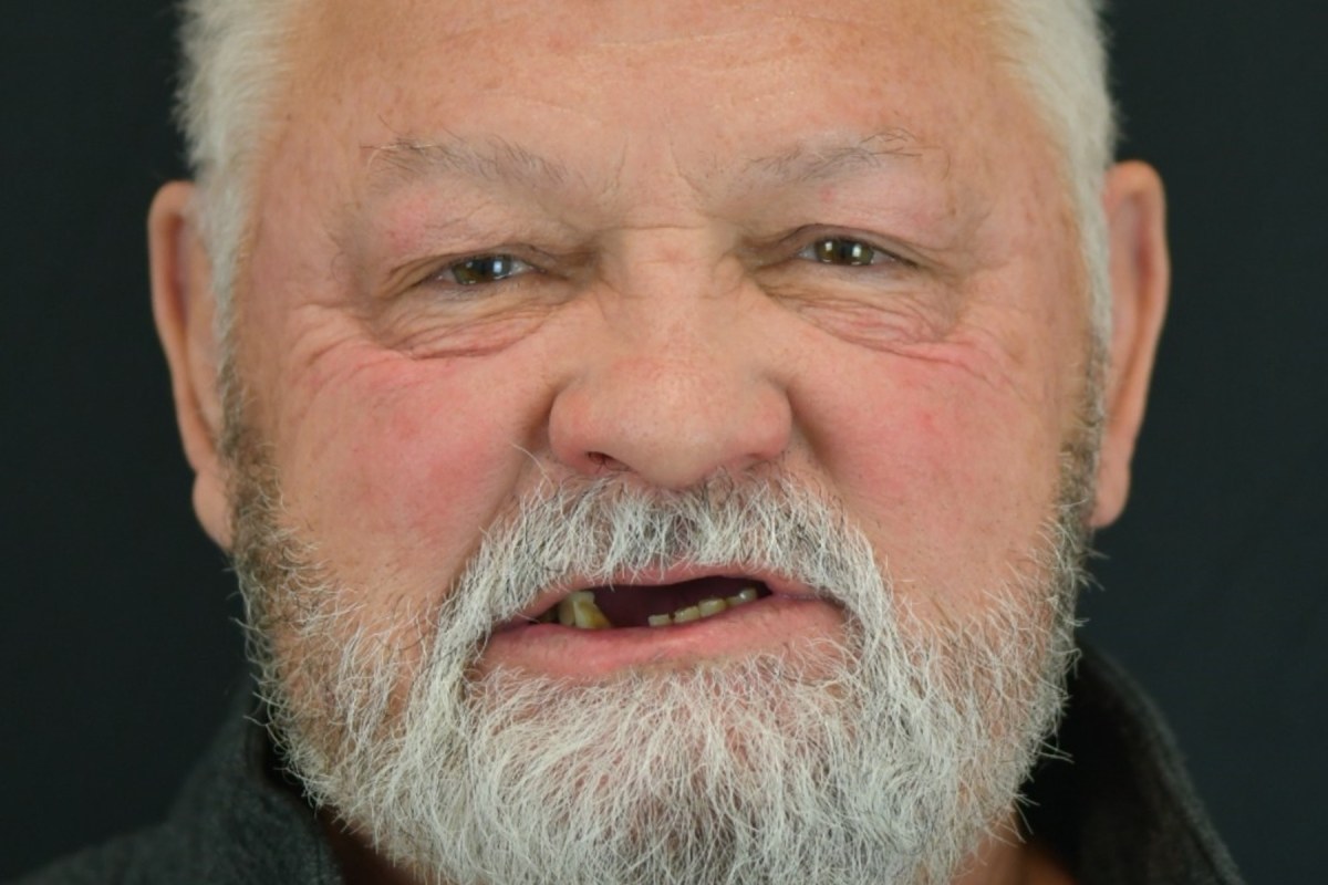 Restore patient before dental implant treatment