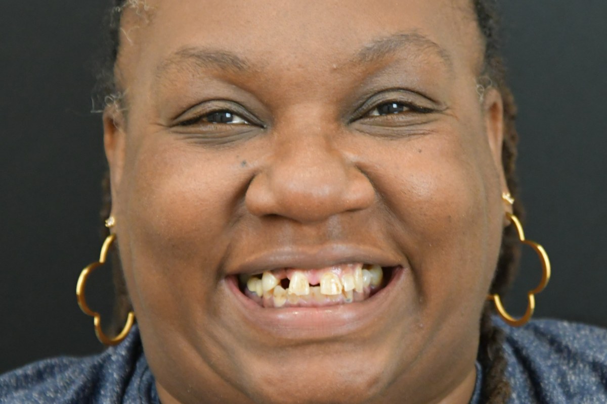 Restore patient before dental implant treatment