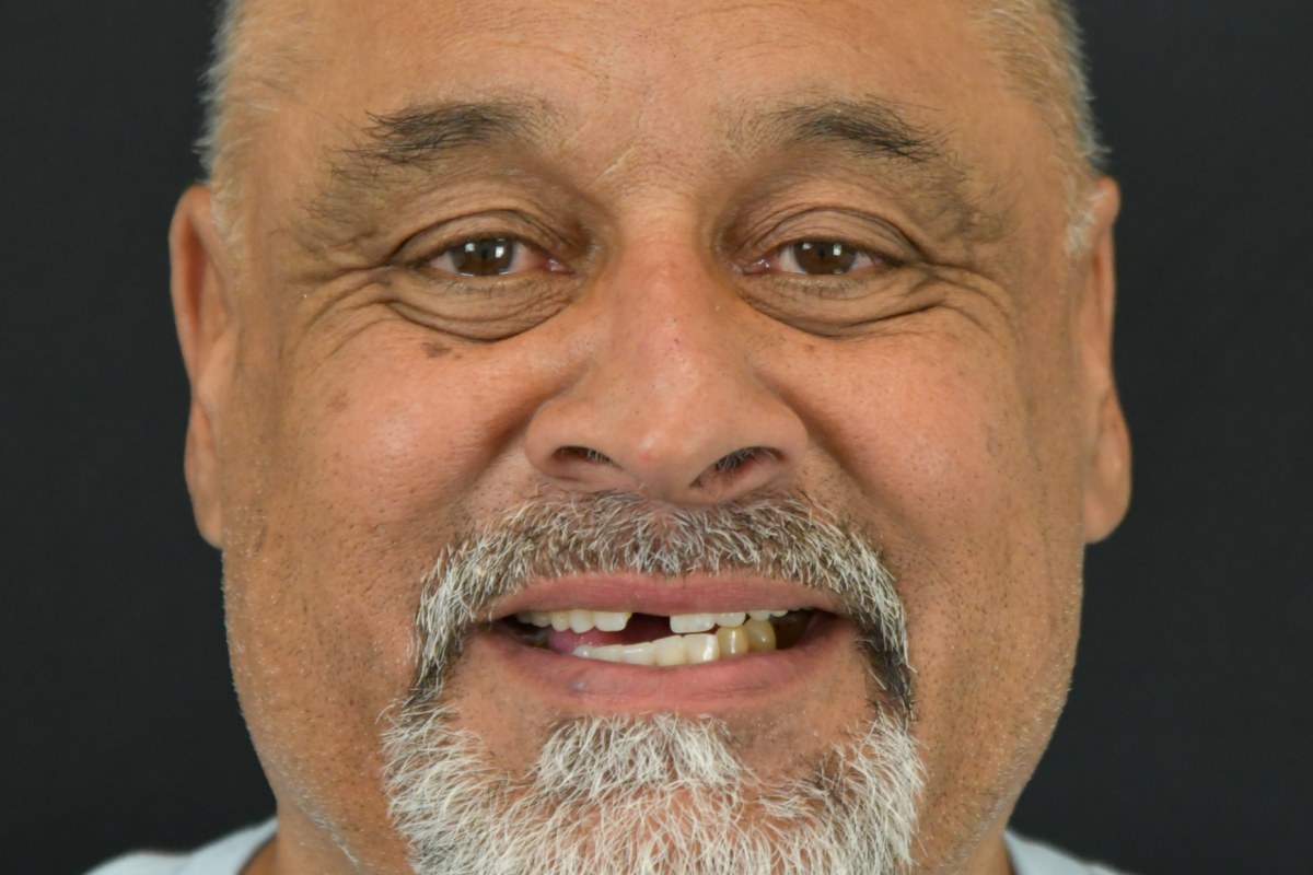 Restore patient before dental implant treatment