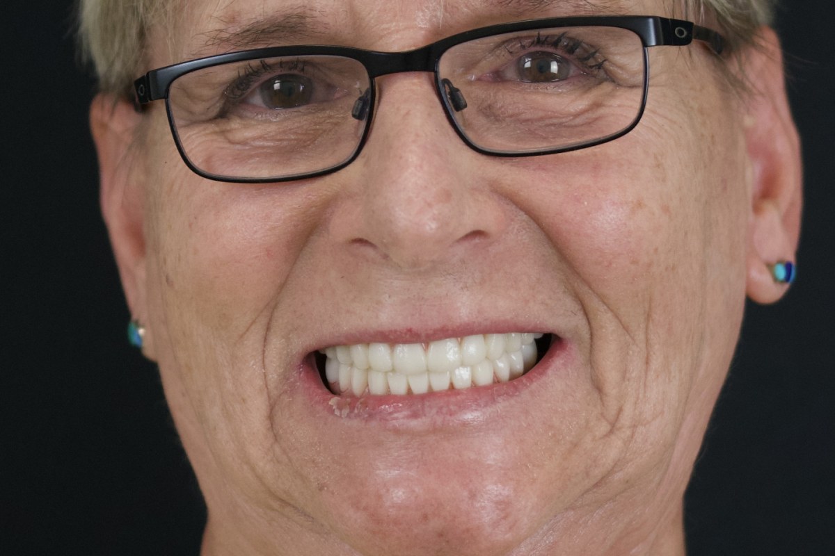 Restore patient after dental implant treatment
