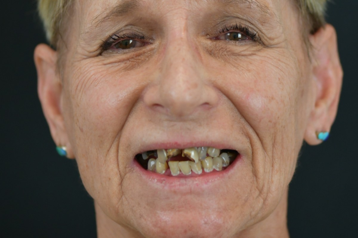 Restore patient before dental implant treatment