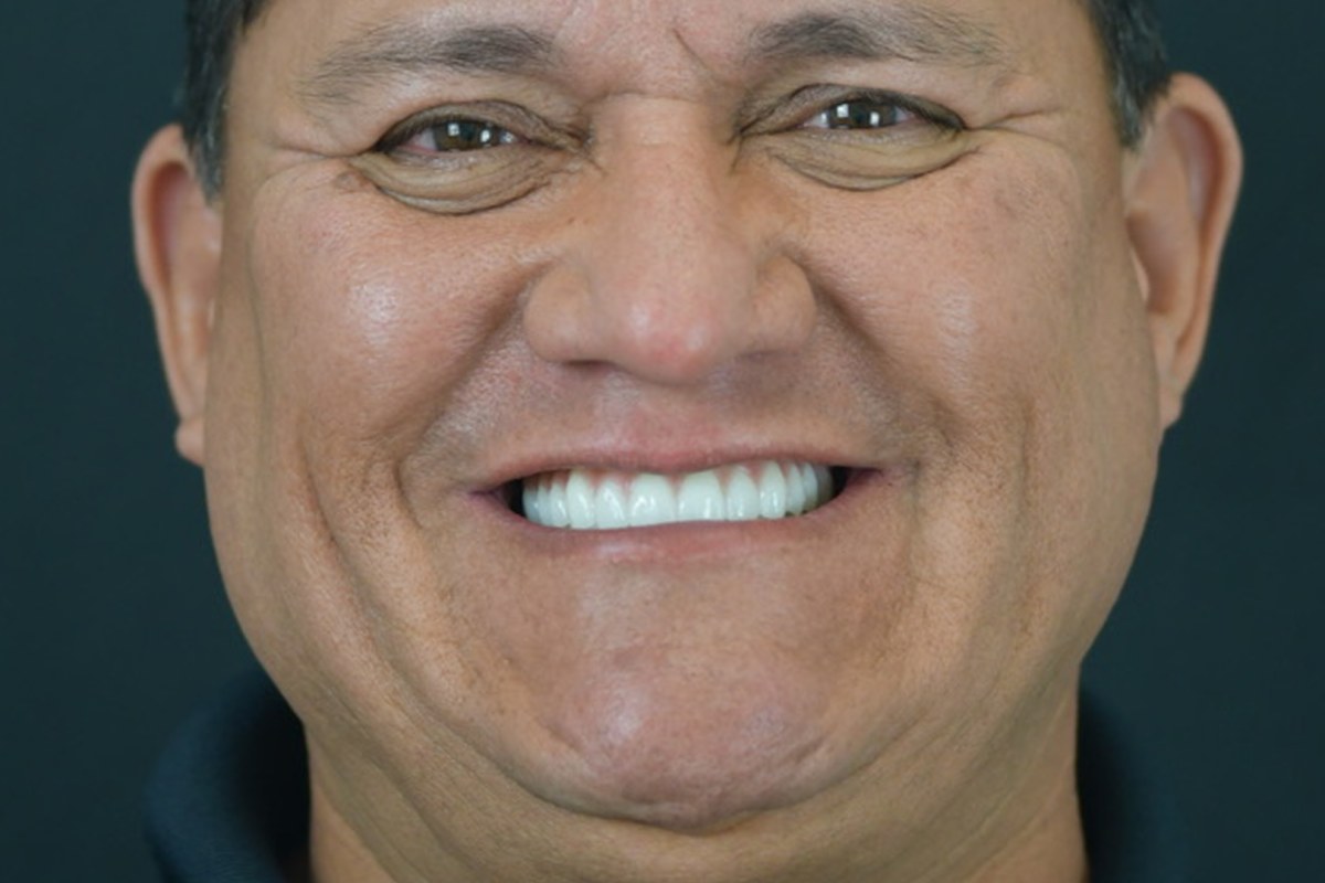 Restore patient after dental implant treatment