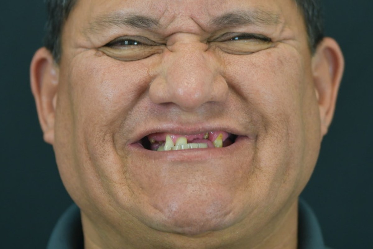 Restore patient before dental implant treatment
