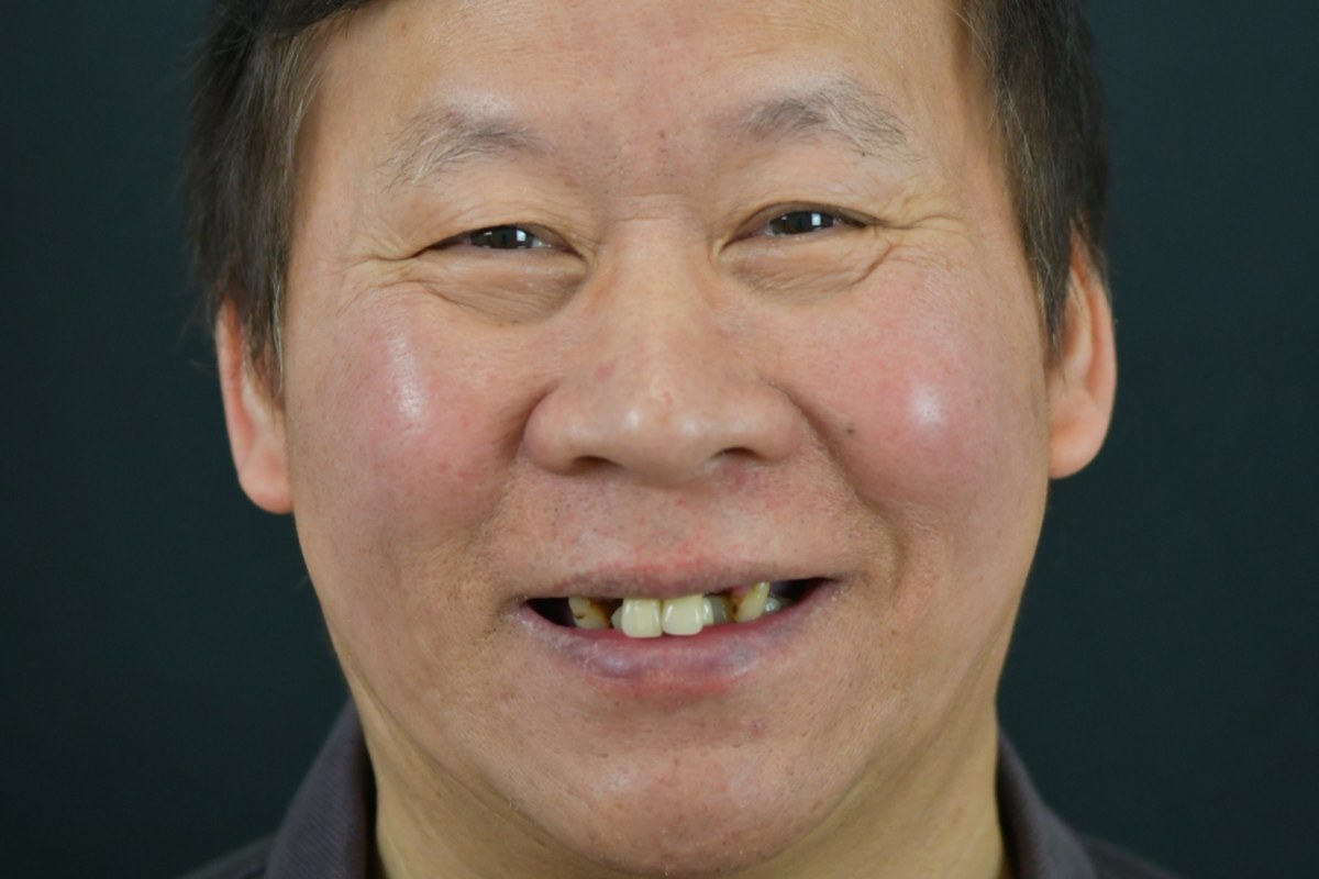 Restore patient before dental implant treatment