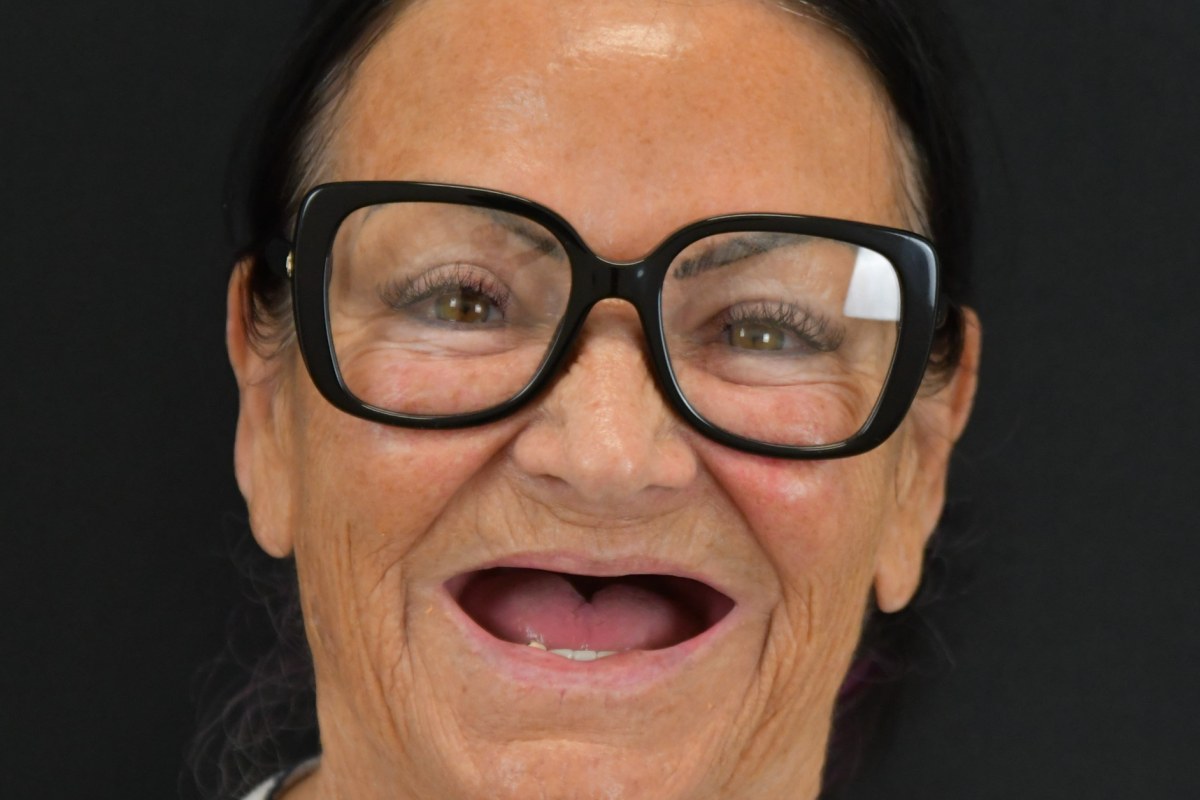 Restore patient before dental implant treatment