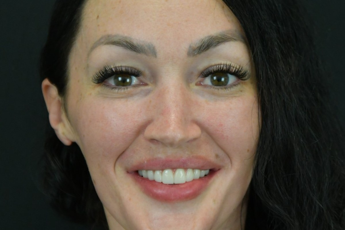 Restore patient after dental implant treatment