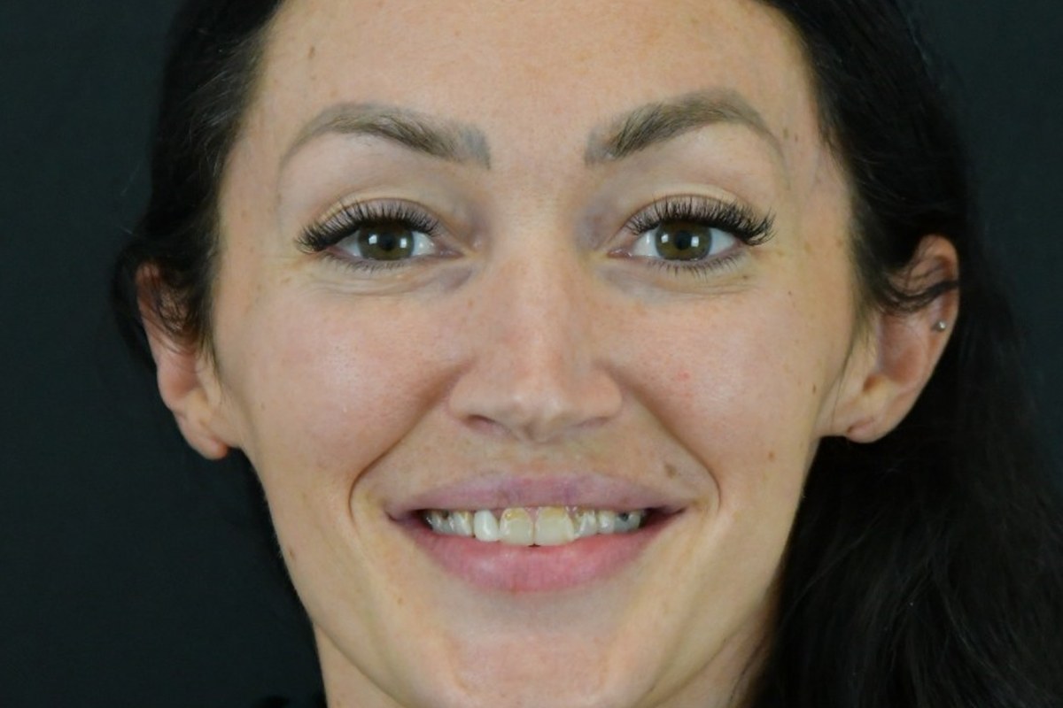 Restore patient before dental implant treatment